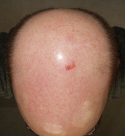 My scraped head